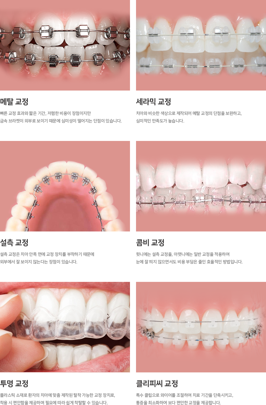메탈 교정(빠른 교정 효과와 짧은 기간, 저렴한 비용이 장점이지만
                                        금속 브라켓이 외부로 보이기 때문에 심미성이 떨어지는 단점이 있습니다.),세라믹 교정(치아와 비슷한 색상으로 제작되어 메탈 교정의 단점을 보완하고,
                                        심미적인 만족도가 높습니다.),설측 교정(설측 교정은 치아 안쪽 면에 교정 장치를 부착하기 때문에
                                        외부에서 잘 보이지 않는다는 장점이 있습니다.),콤비교정(윗니에는 설측 교정을, 아랫니에는 일반 교정을 적용하여
                                        눈에 잘 띄지 않으면서도 비용 부담은 줄인 효율적인 방법입니다.),투명 교정(플라스틱 소재로 환자의 치아에 맞춤 제작된 탈착 가능한 교정 장치로,
                                        착용 시 편안함을 제공하며 필요에 따라 쉽게 착탈할 수 있습니다.),클리피씨 교정(특수 클립으로 와이어를 조절하여 치료 기간을 단축시키고,
                                        통증을 최소화하여 보다 편안한 교정을 제공합니다.)